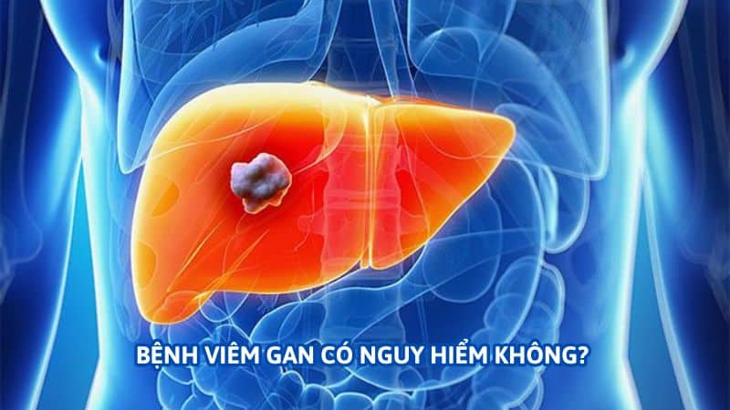 Trường Thọ - benh viem gan