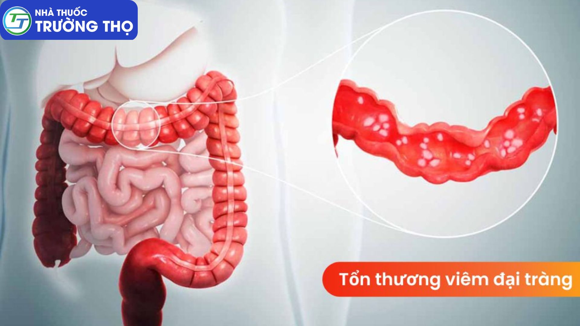 Viêm đại tràng là gì? - Là các tổn thương viêm loét trên niêm mạc