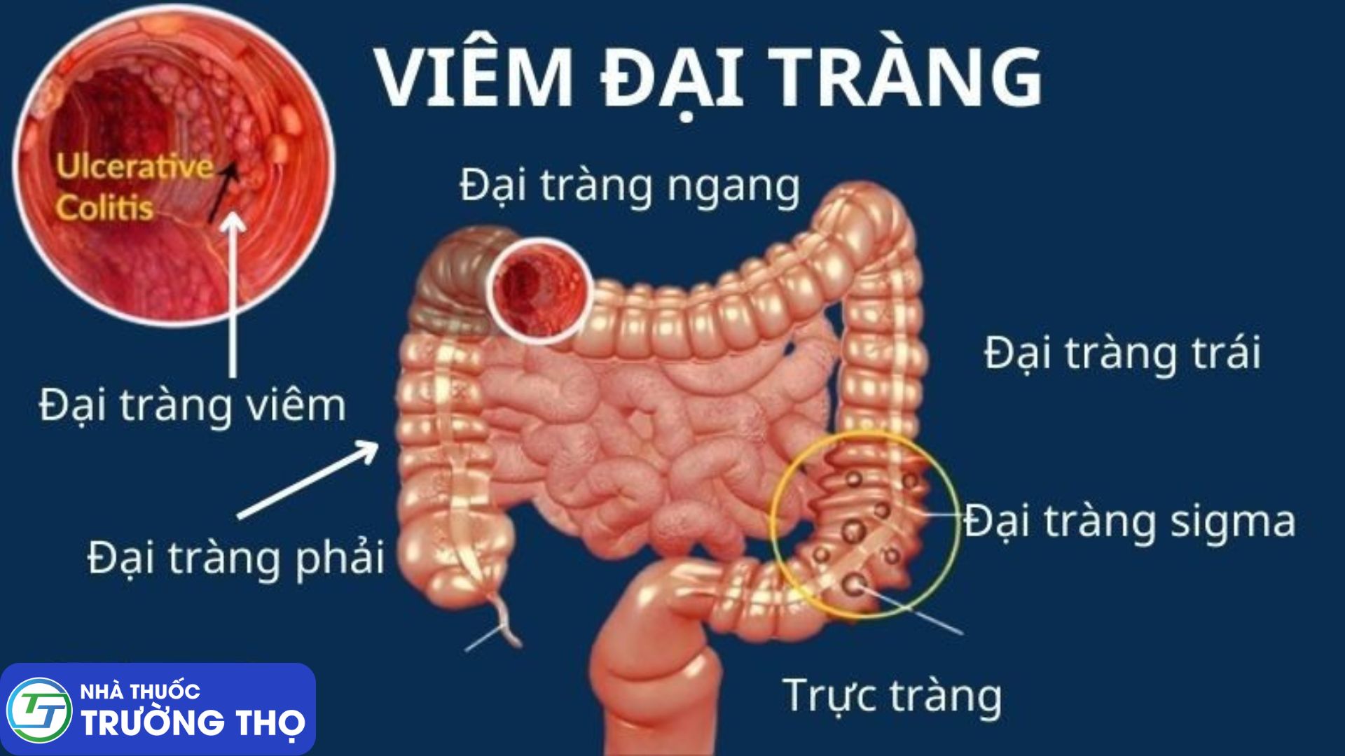 Viêm đại tràng là bệnh dễ mắc phải ở người Việt