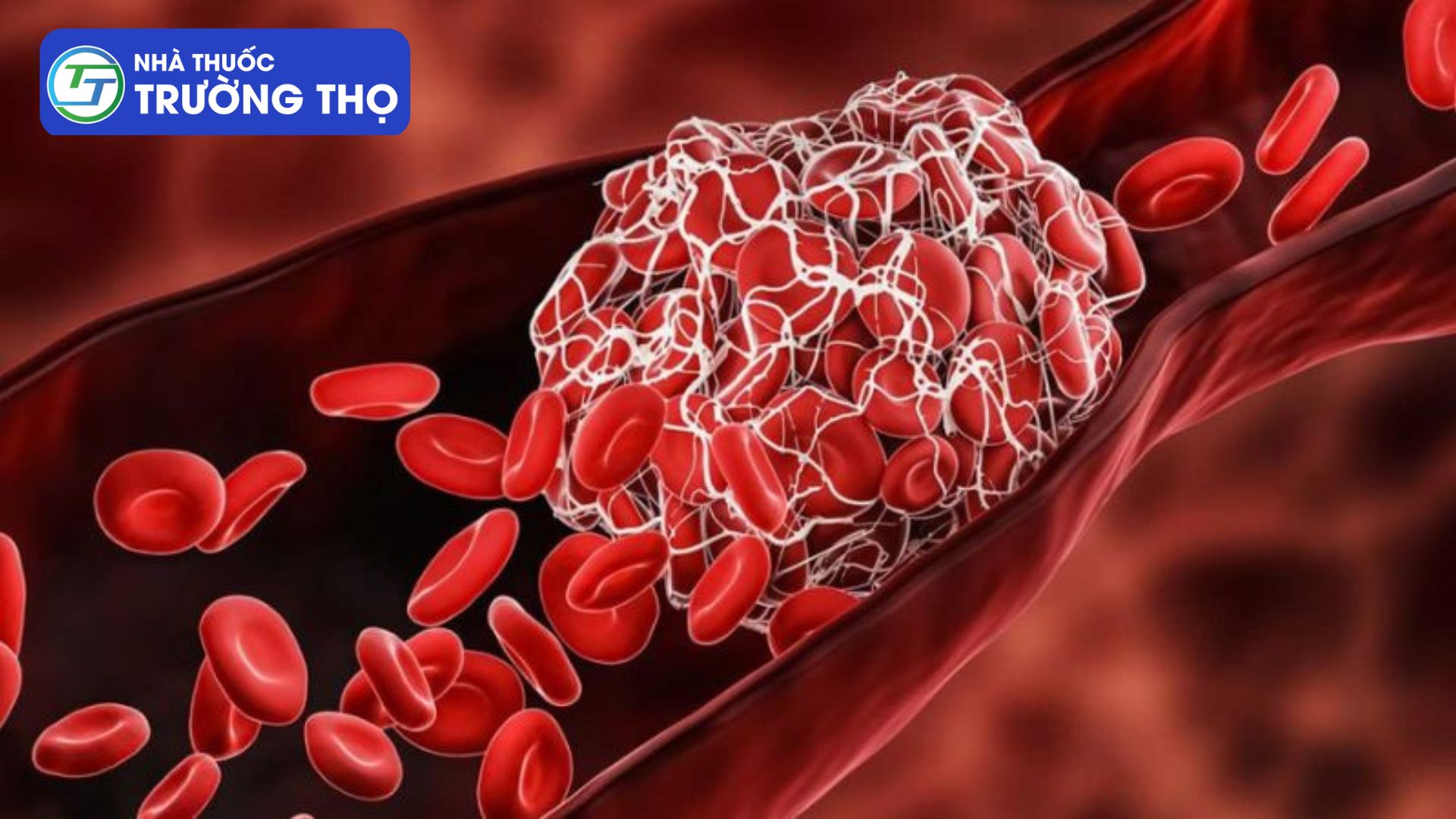 Có nhiều nguyên nhân gây ra cục máu đông