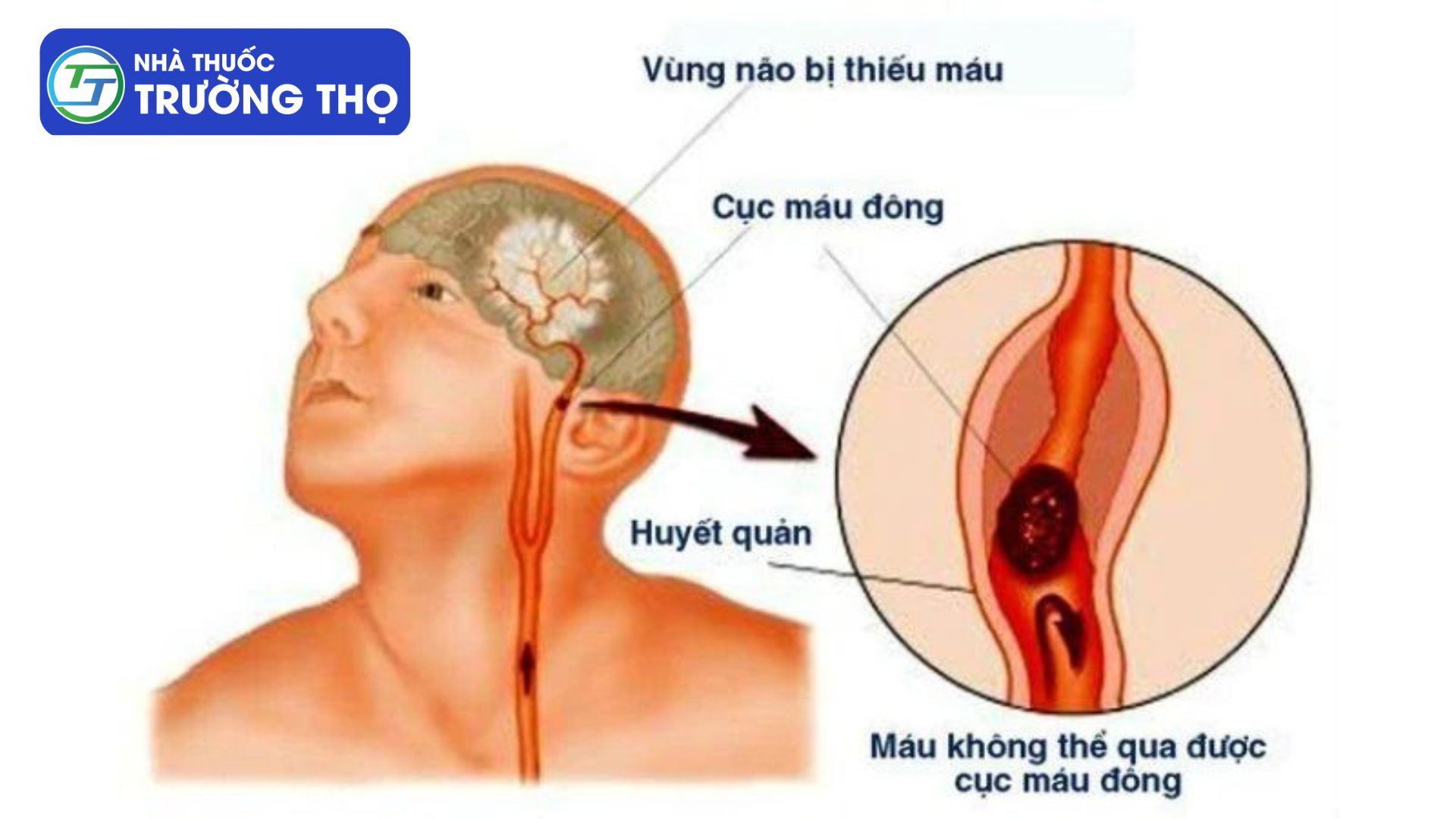 Cục máu đông ở não gây đau đầu, méo miệng,... thậm chí đột quỵ