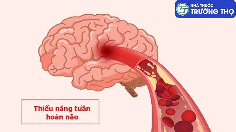 Thiểu năng tuần hoàn não (hay còn gọi là rối loạn tuần hoàn não)